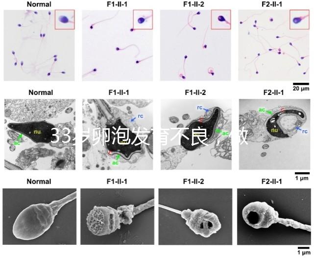 33歲卵泡發(fā)育不良，做試管黃體期促排方案失敗怎么辦？